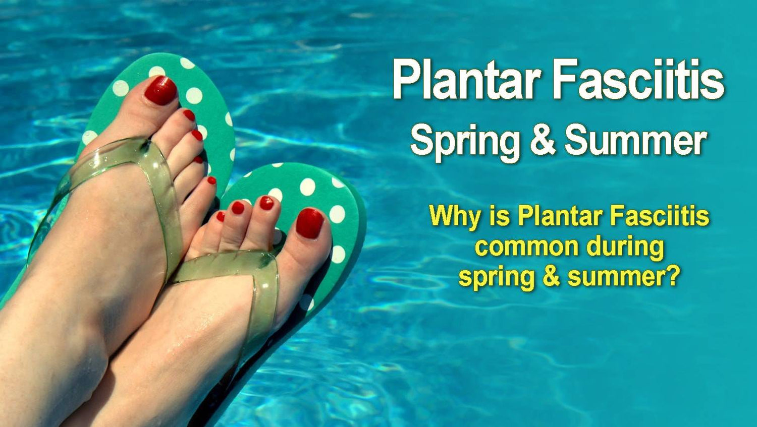 Plantar Fasciitis common in spring summer