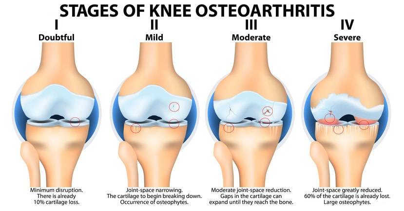 Osteoarthritis Causes, Symptoms and Treatment