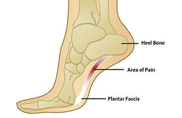 painful sole of foot