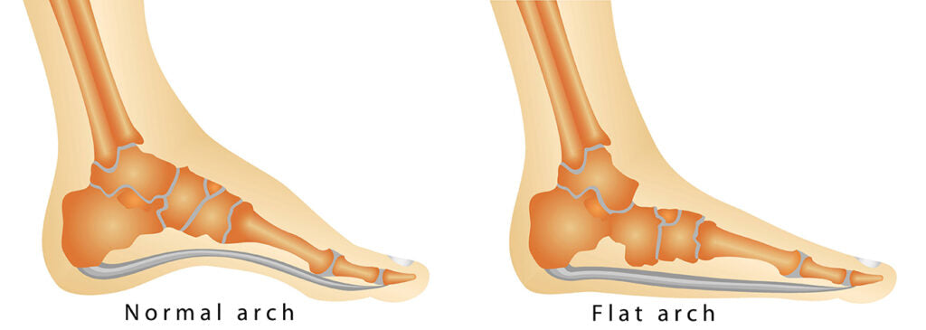 Fallen Arches: Symptoms, Causes, Exercises, Treatment, Diagnosis