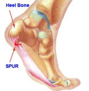 heel pain running treatment